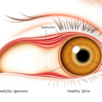 Chalazion